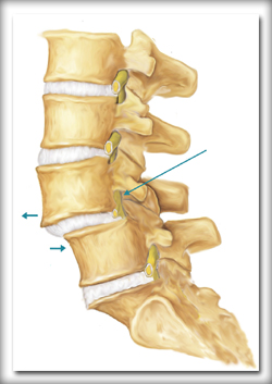 spondylolishthesis-intro